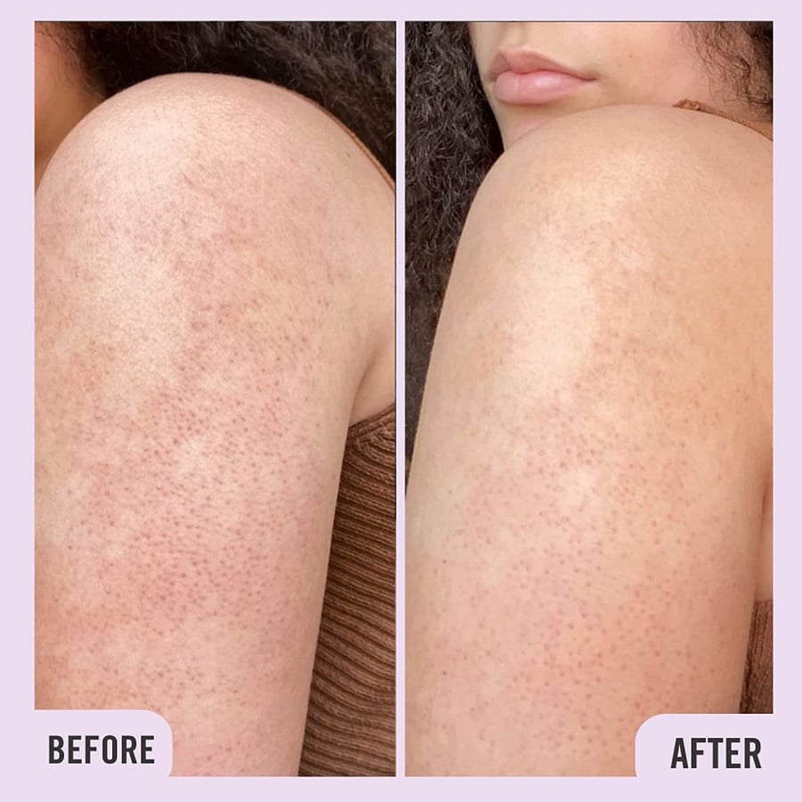First Aid beauty bye bye bumps kit