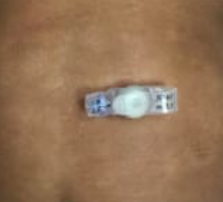 انبوب التغذية المعويه مقاس 18 AVANOS MIC-KEY Gastrostomy Feeding