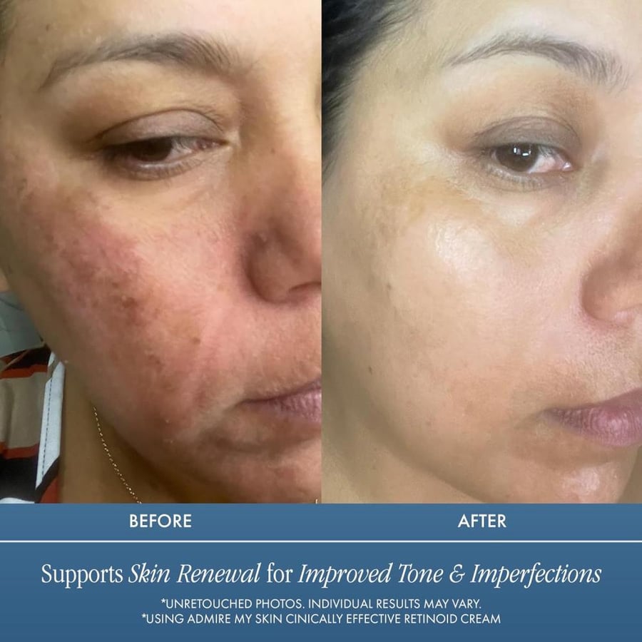 Admire my skin Potent Retinoid Cream Provides Clinical Retinol Results - The Most Effective Retinoic Acid Moisturizer For Acne & Wrinkles