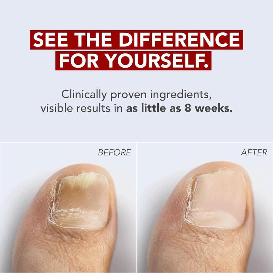 Kerasal Fungal Nail Renewal, Restores Appearance of Discolored or Damaged Nails, 0.33 fl oz