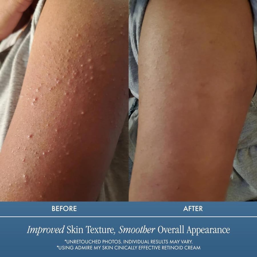 Admire my skin Potent Retinoid Cream Provides Clinical Retinol Results - The Most Effective Retinoic Acid Moisturizer For Acne & Wrinkles