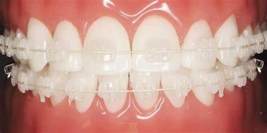Clarity Advanced Ceramic Brackets