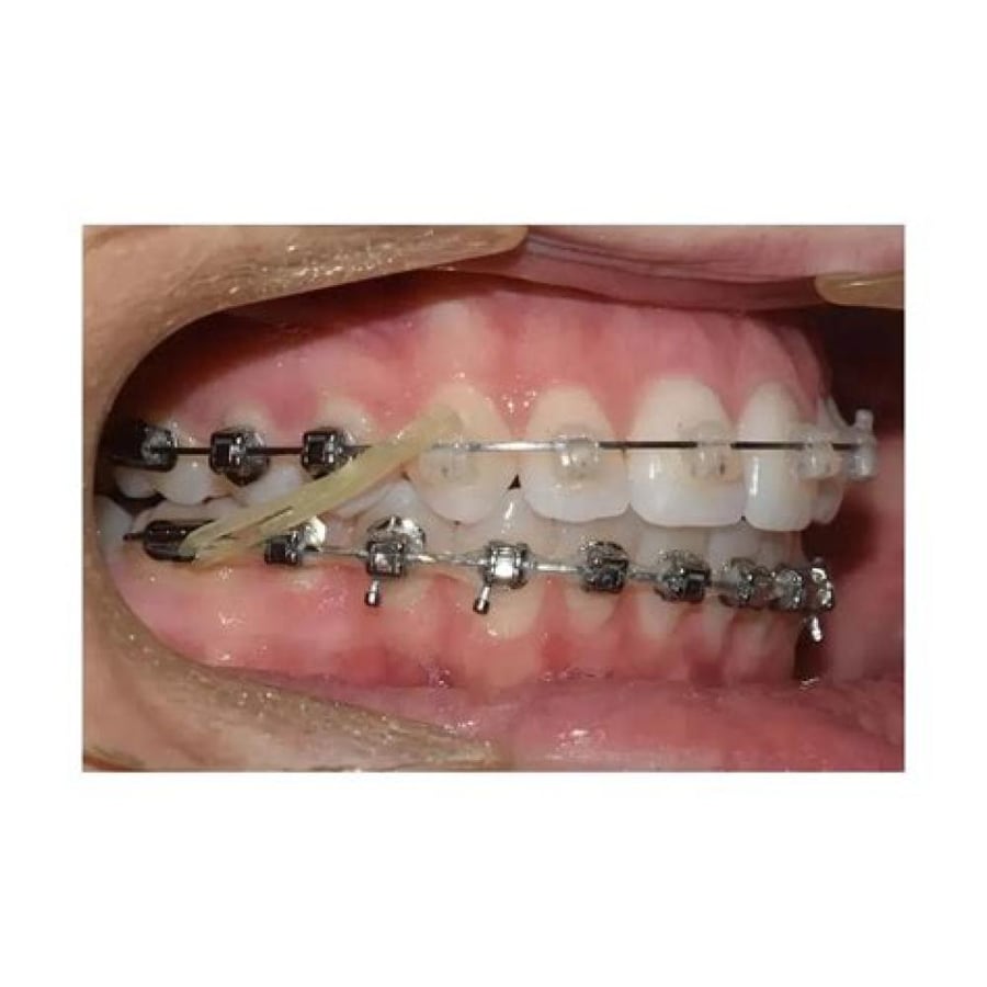 Intraoral Elastics