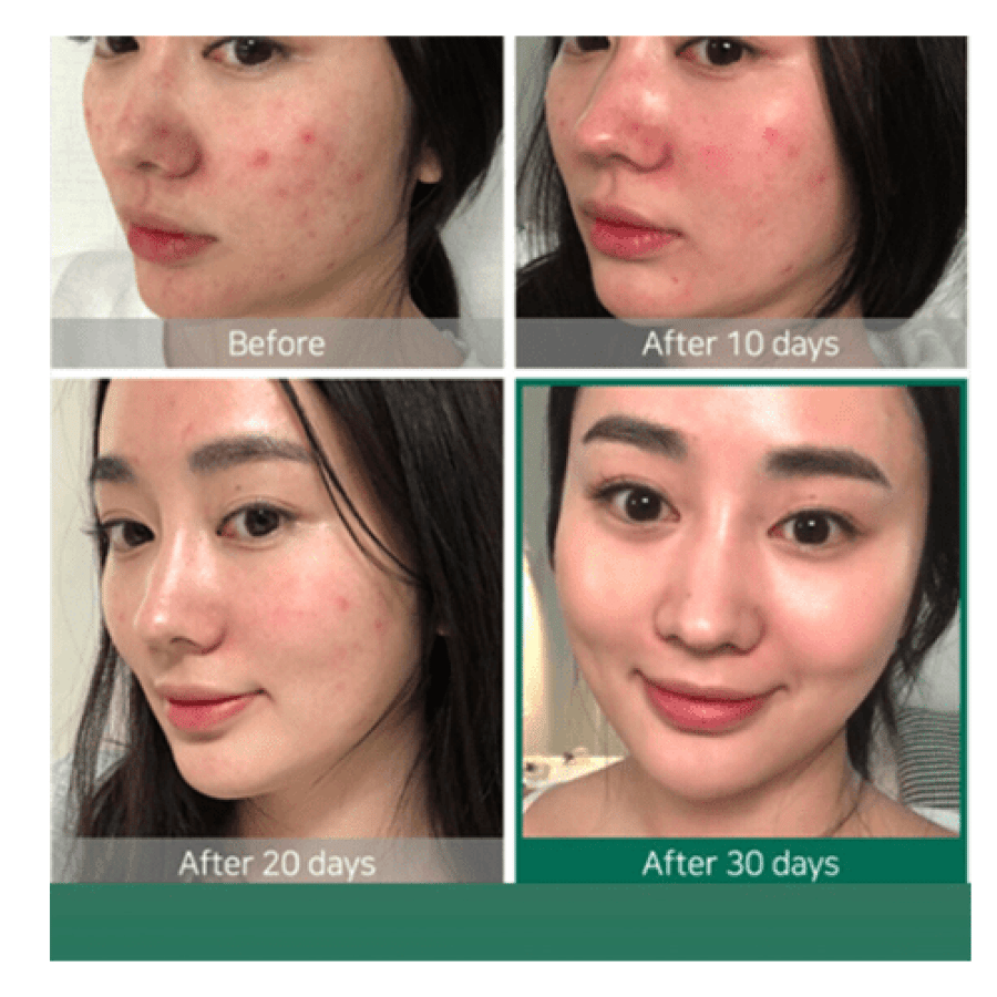 The Ordinary AHA 30% + BHA 2% Peeling Solution - 30ml