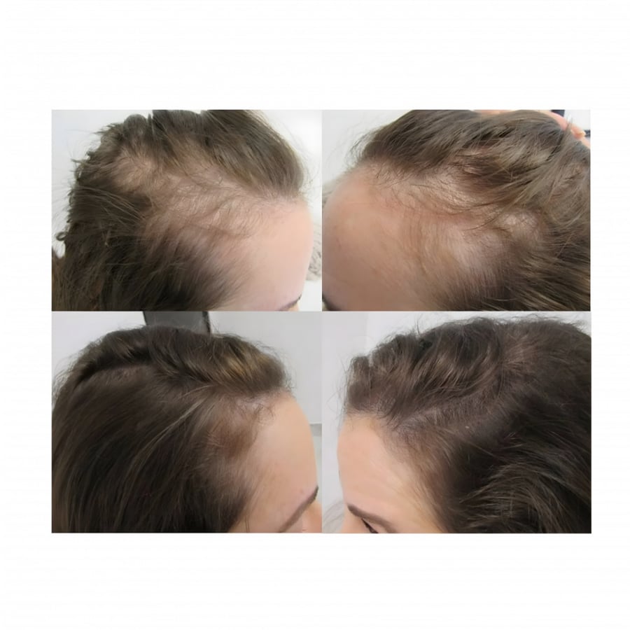 لاف مي نيو هير لنمو الشعر من الجذور 120 مل + ديرما رول 0.5 - New Hair love me 120 ml