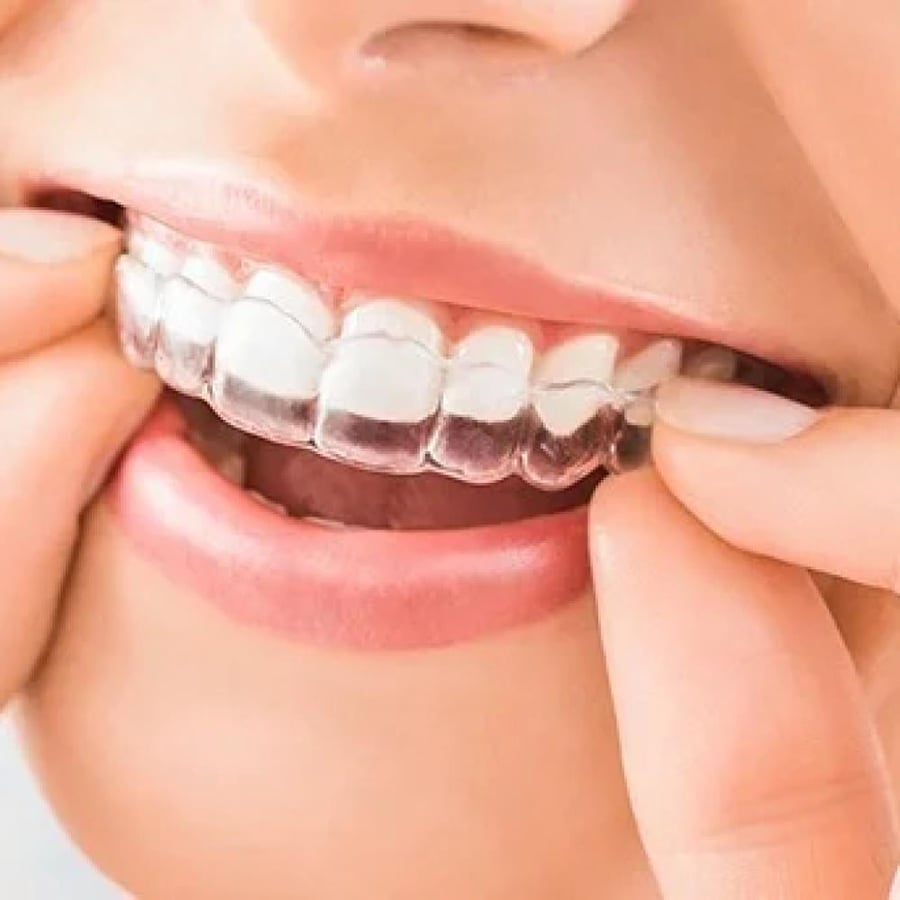 الدفعة الأولى للتقويم الشفاف