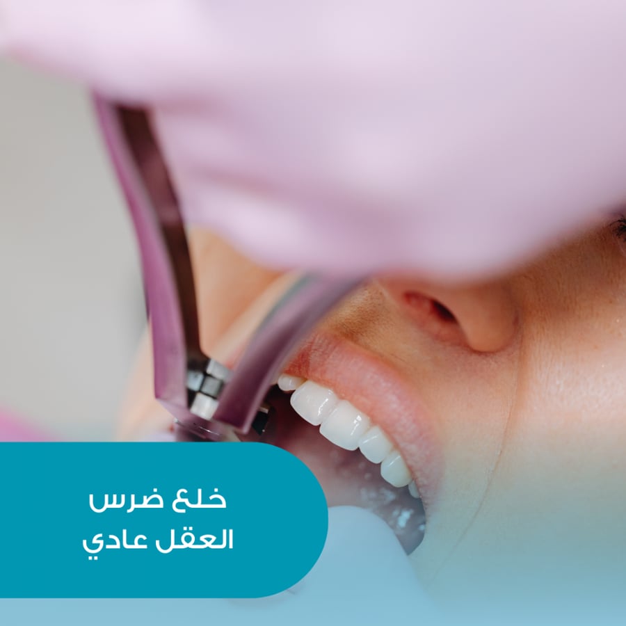 خلع ضرس العقل العادي