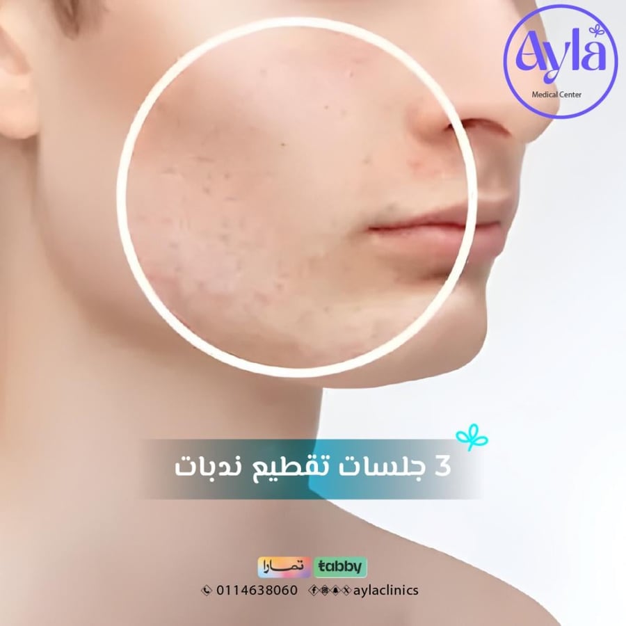 3 جلسة تقطيع ندبات