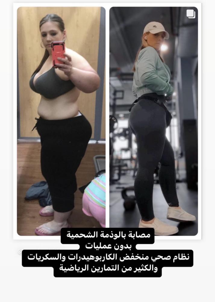 العيش مع الليبوديما