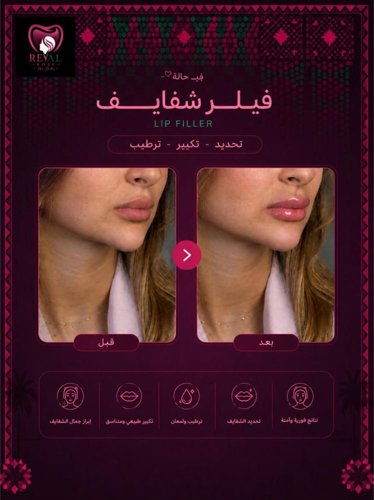 1مل فيلر + 1مل بوتكس