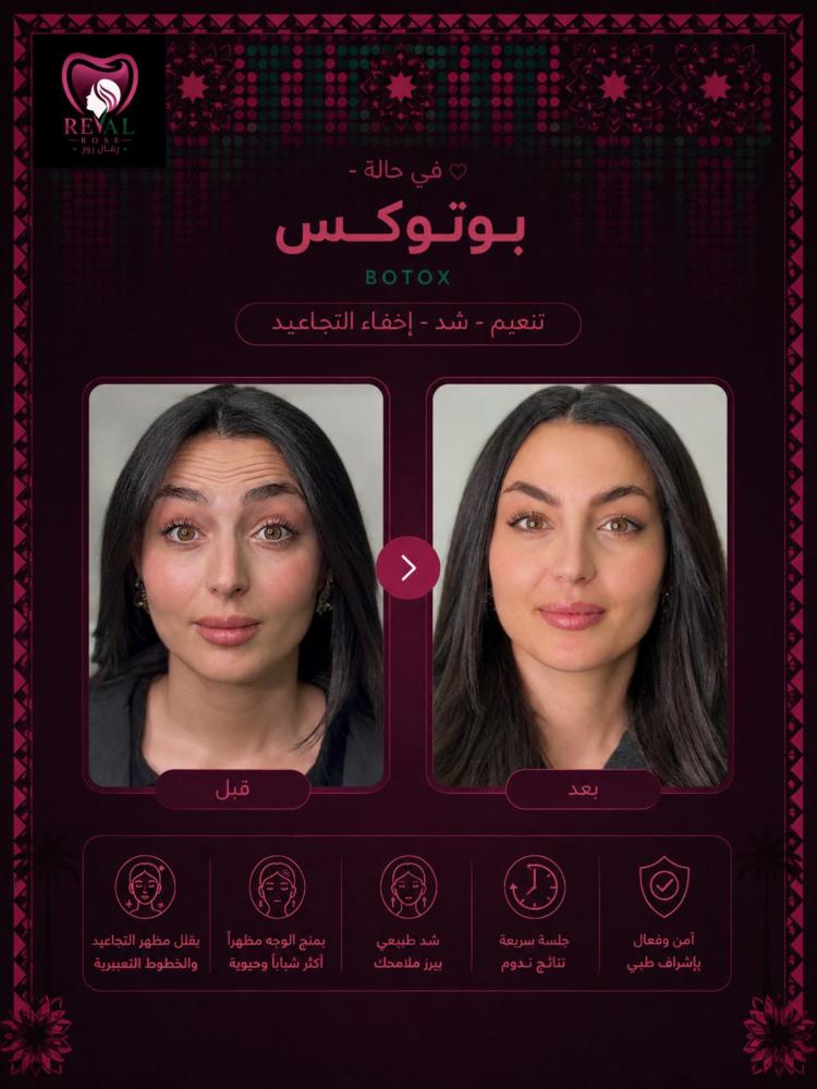 1مل فيلر + 1مل بوتكس