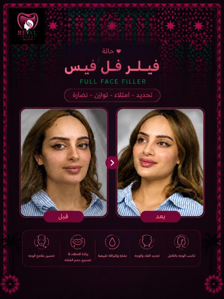 1مل فيلر + 1مل بوتكس