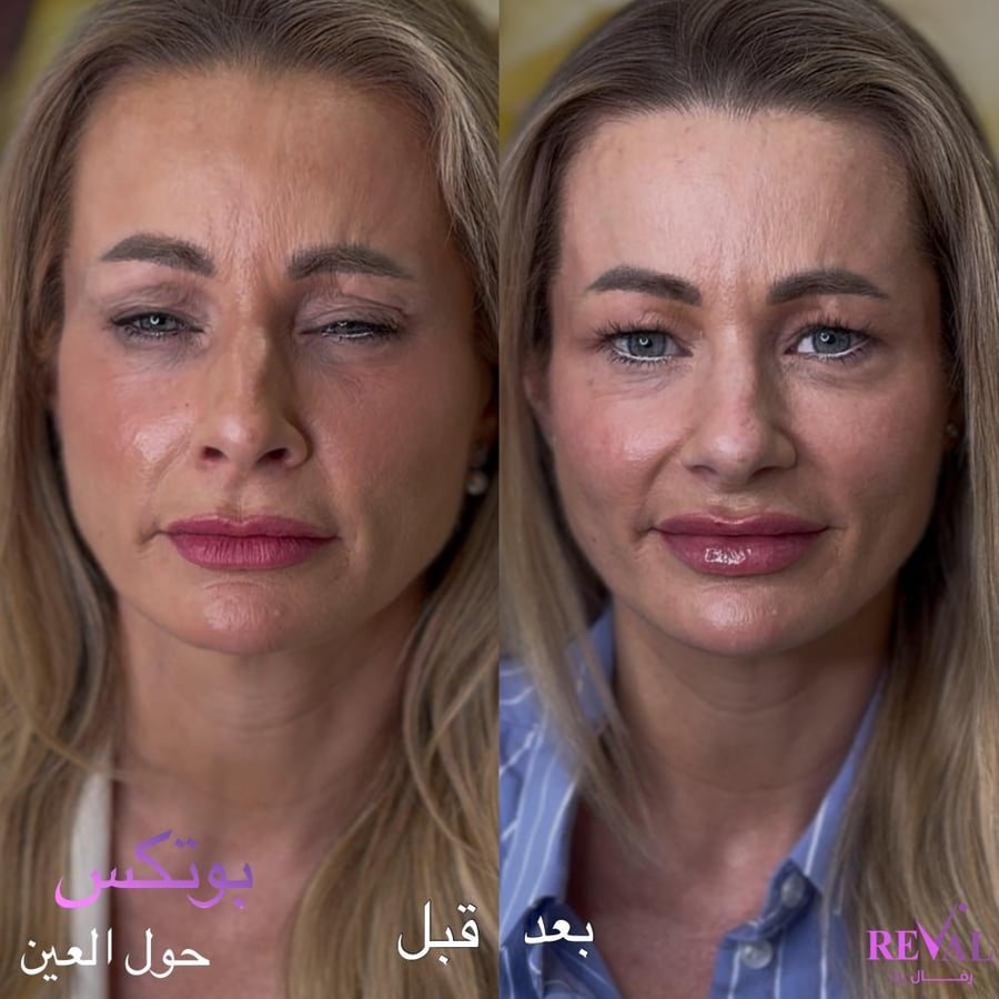بوتكس تعرق
