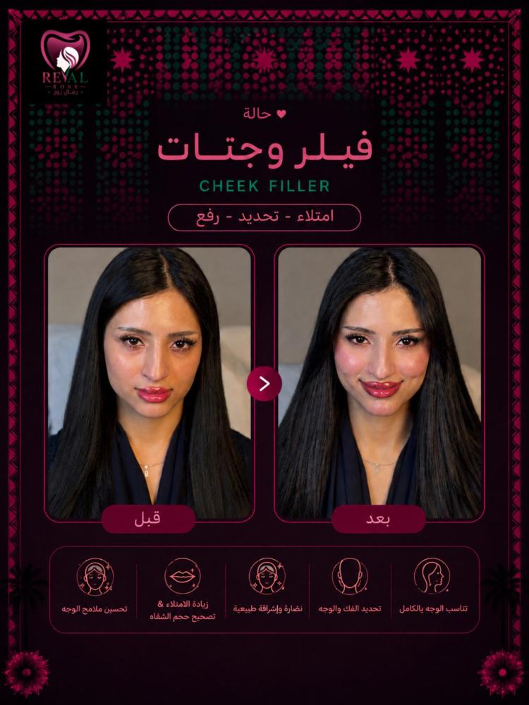 1مل فيلر + 1مل بوتكس