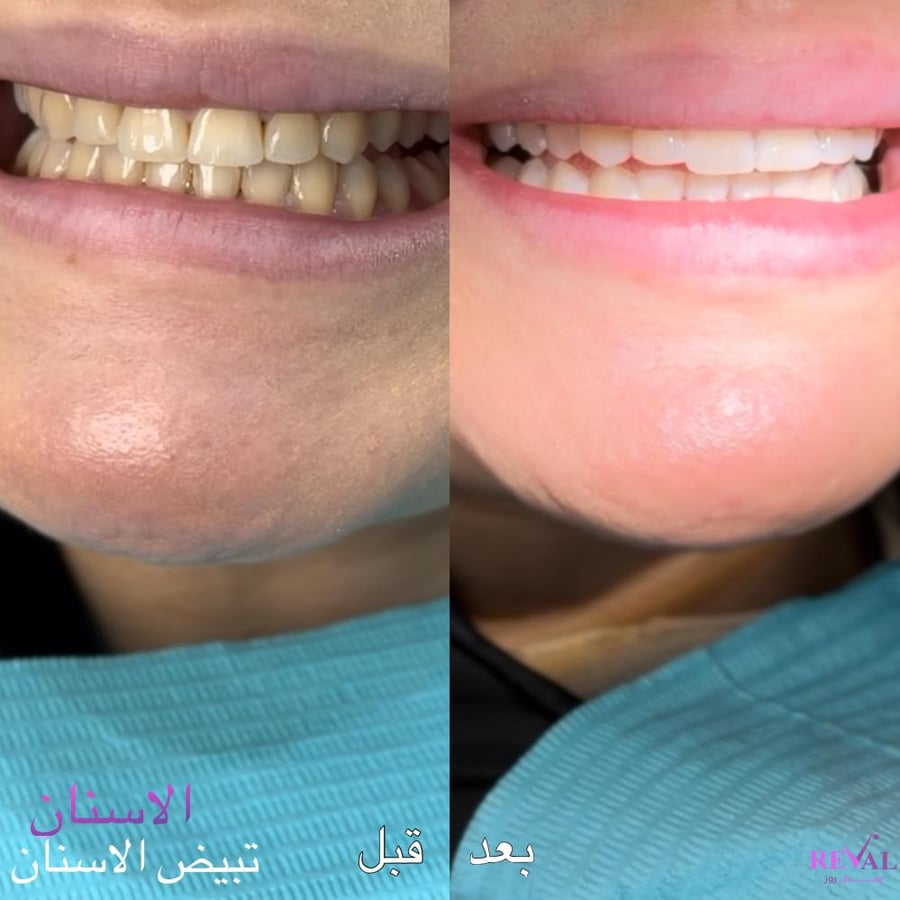 تبييض أسنان بالليزر + تنظيف اسنان+1مل فيلر