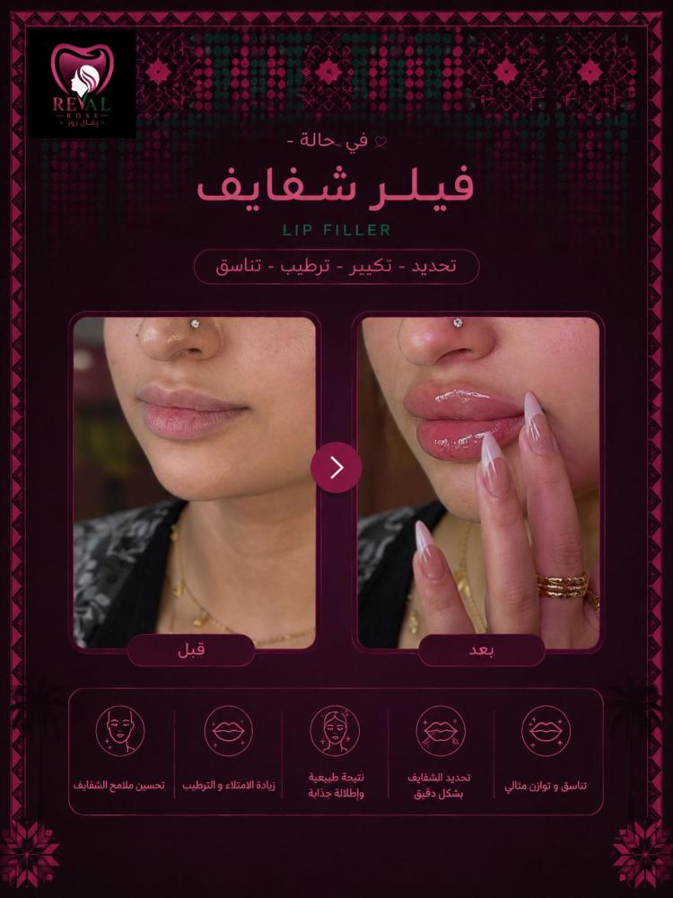 1مل فيلر + 1مل بوتكس