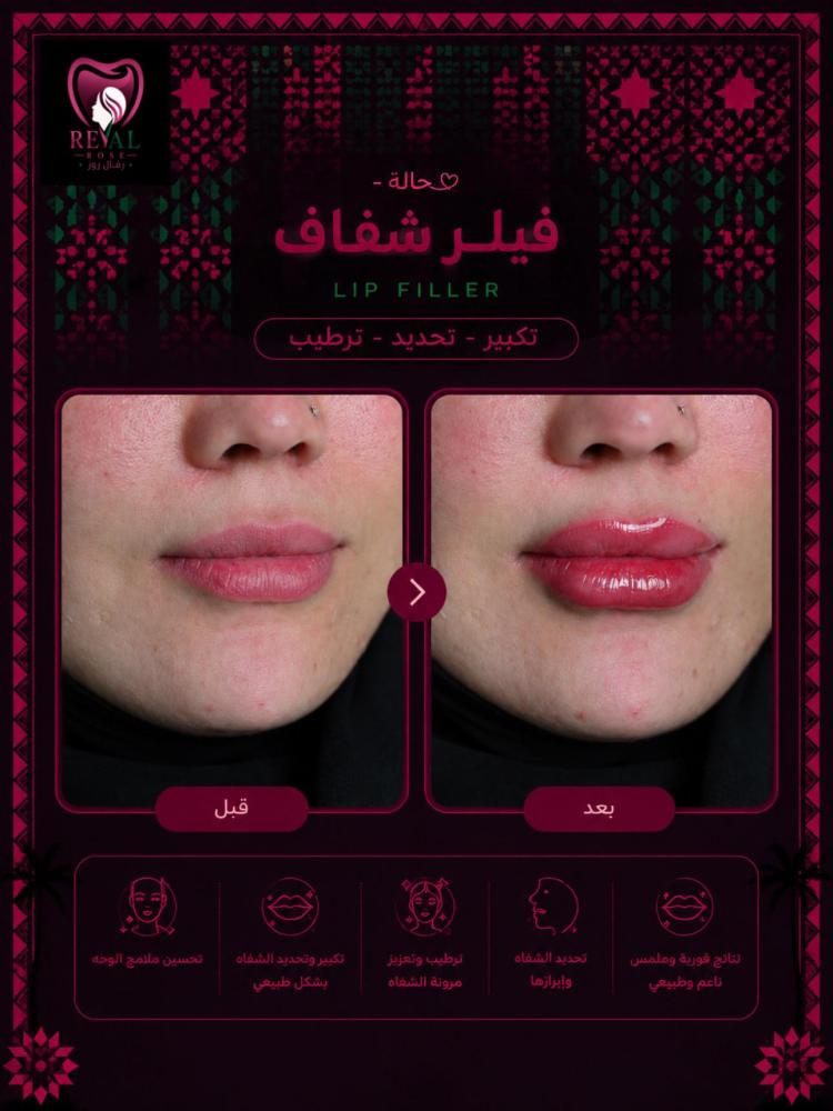 1مل فيلر + 1مل بوتكس