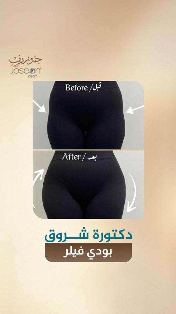 بدي فيلر 10 مل