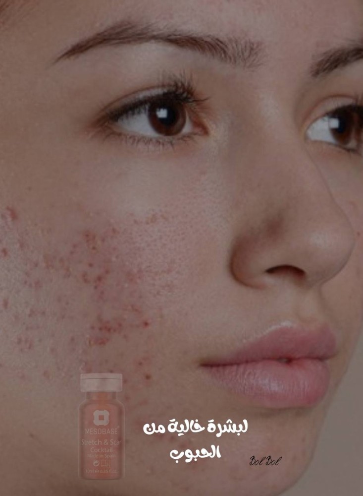 Mesotherapy Stretch & Scar Cocktail