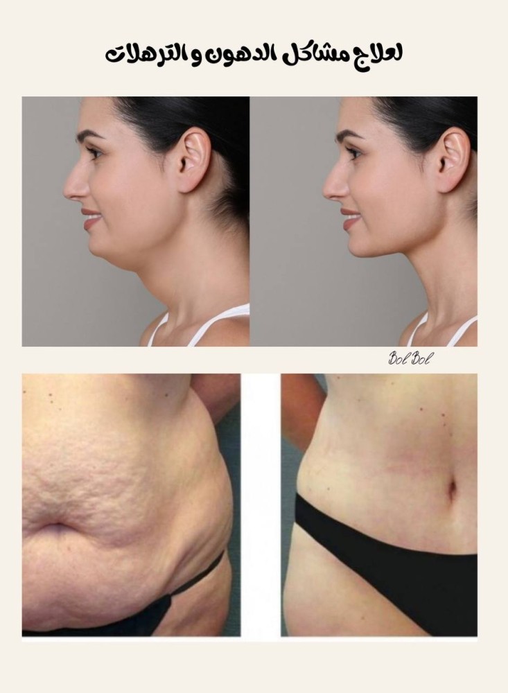 Mesotherapy Lipolytic Cocktail