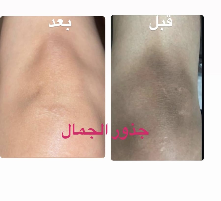 صابونيه + كريم تفتيح