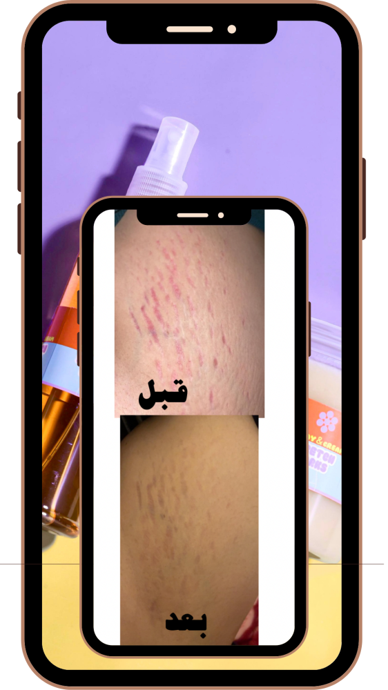 بكج 2 ازالة الخطوط البيضاء والحمراء