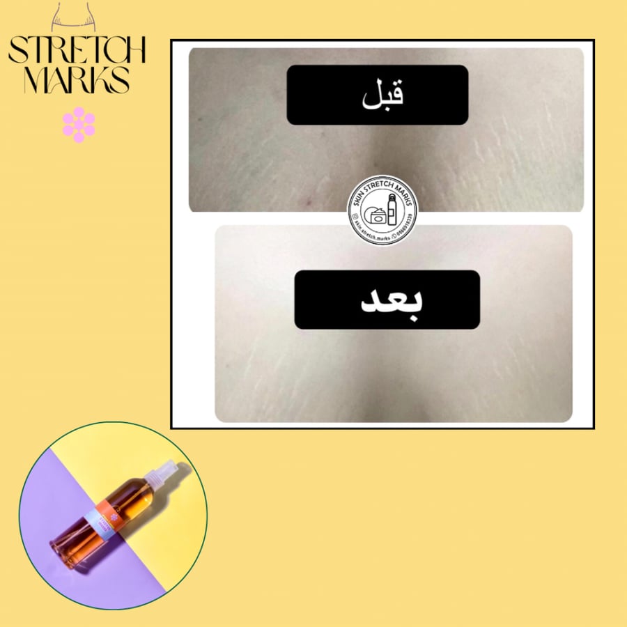 محلول ازالة الخطوط البيضاء والحمراء