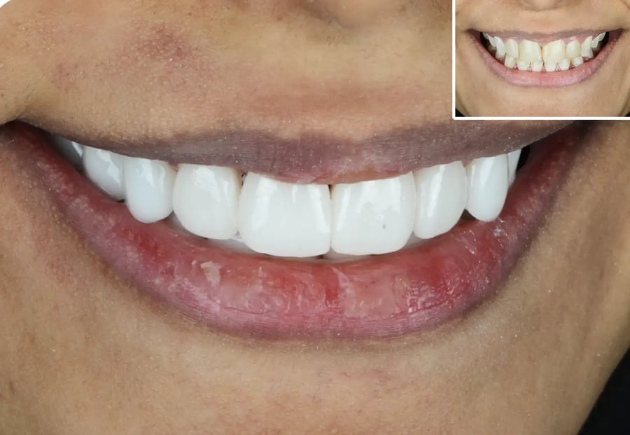 عدسات ١٦ سن لومنير