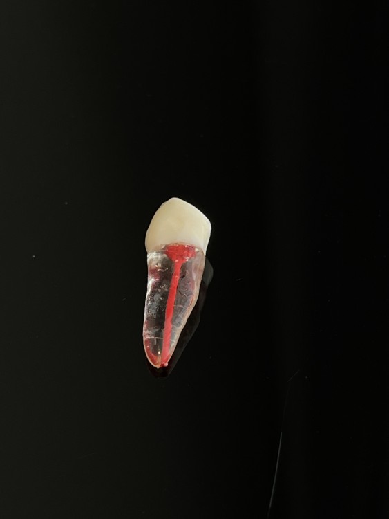 Endo tooth plastic