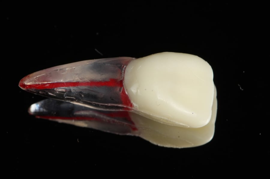 Endo tooth plastic