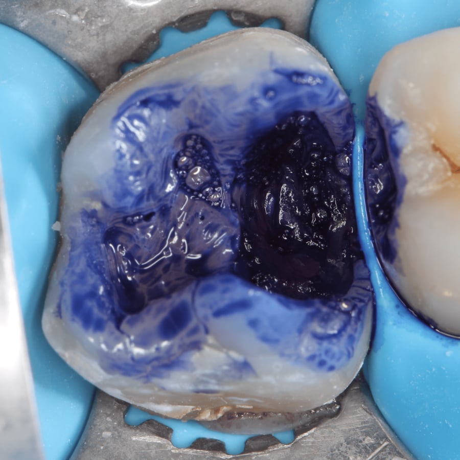 صبغة كاشف التسوس Caries Detecting Dye