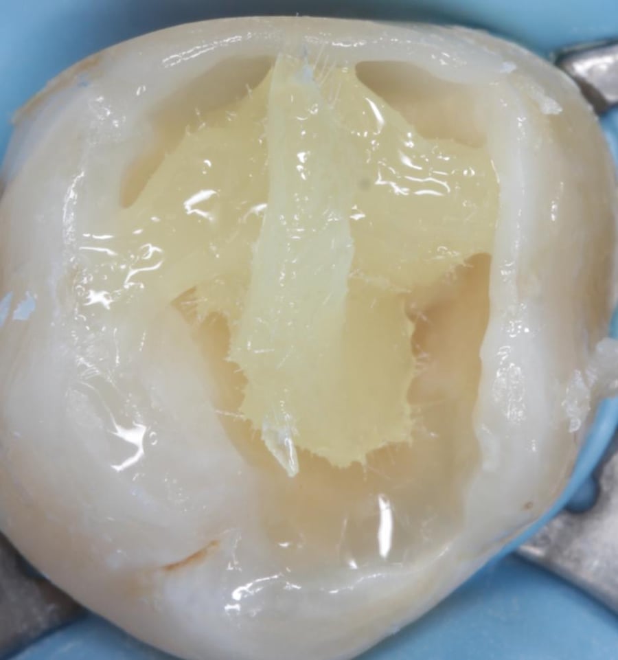 everX posterior per 1 capsule