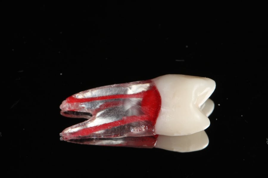 Endo tooth plastic