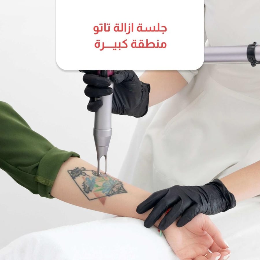 جلسة إزالة تاتو  منظقة كبيرة