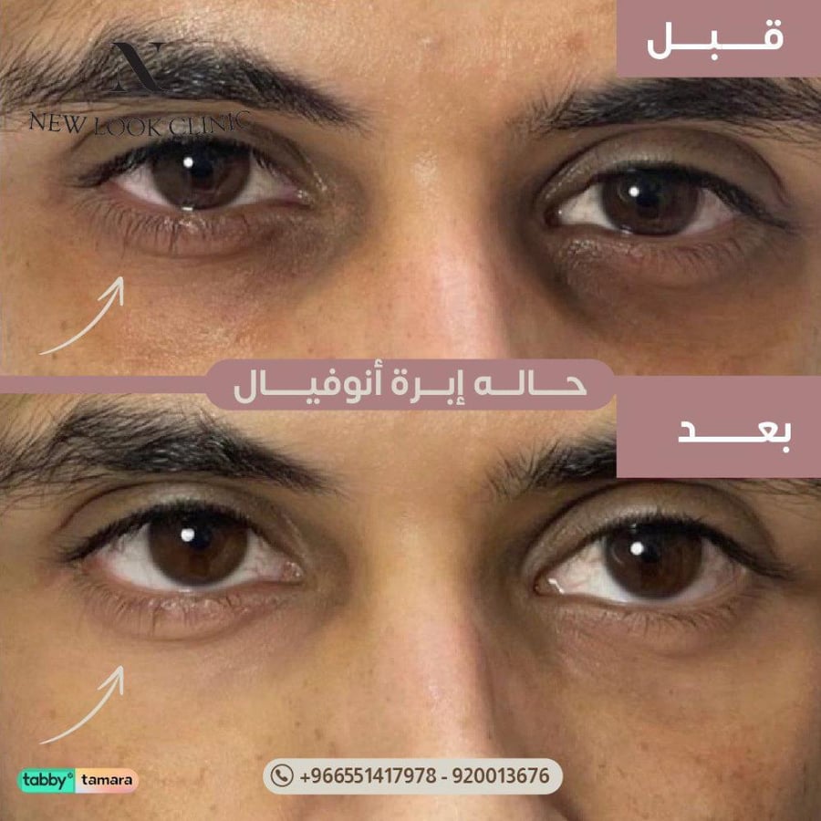 علاج الهالات السوداء بالانوفيال ⚡