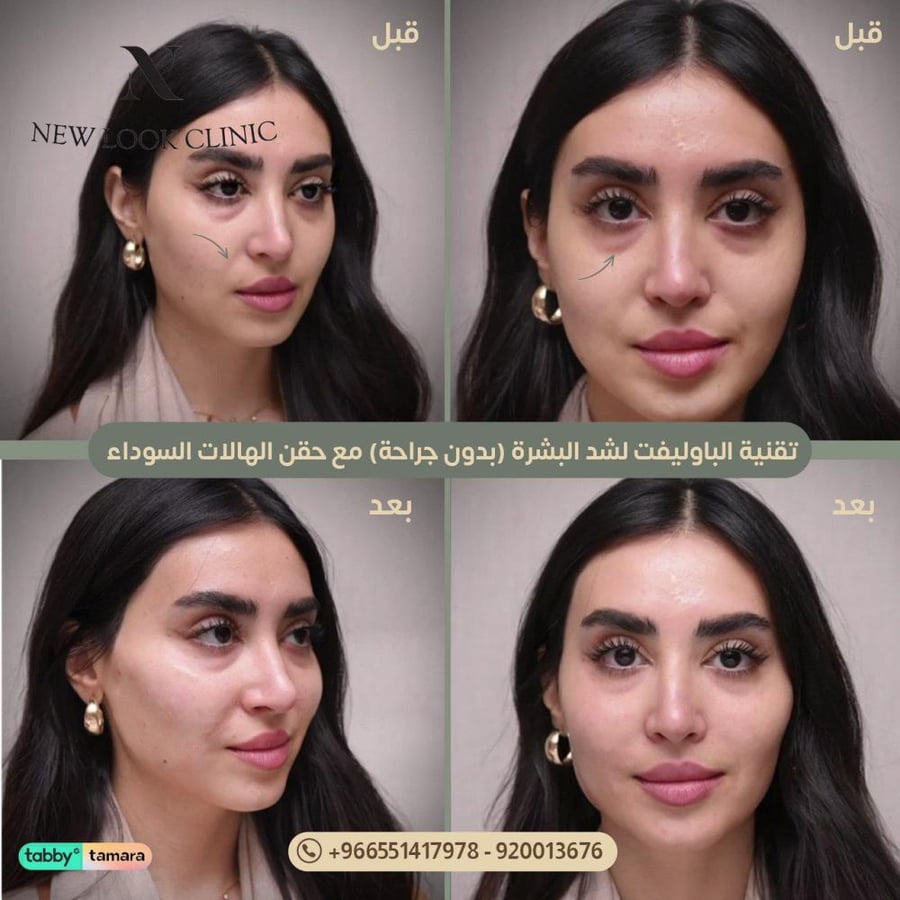 جلسه الباوليفت لشد البشره  ( الشد الغير جراحى )