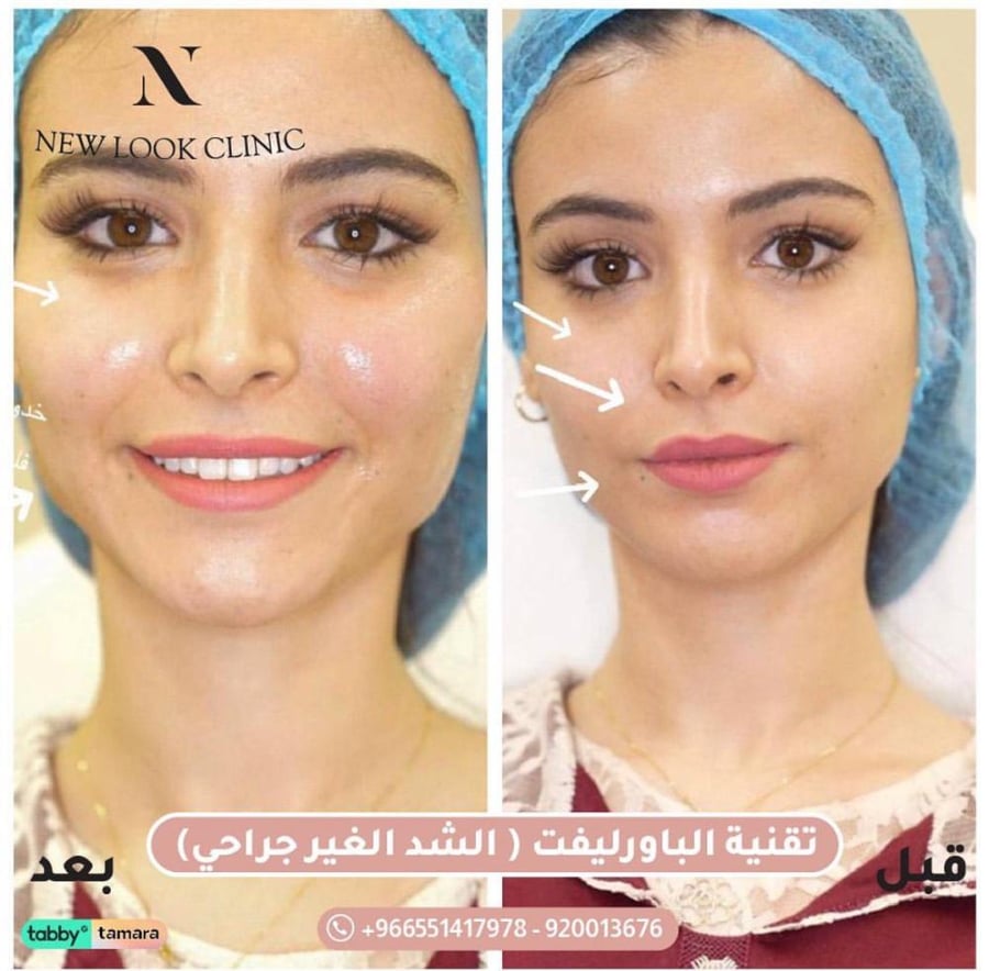 جلسه الباوليفت لشد البشره  ( الشد الغير جراحى )