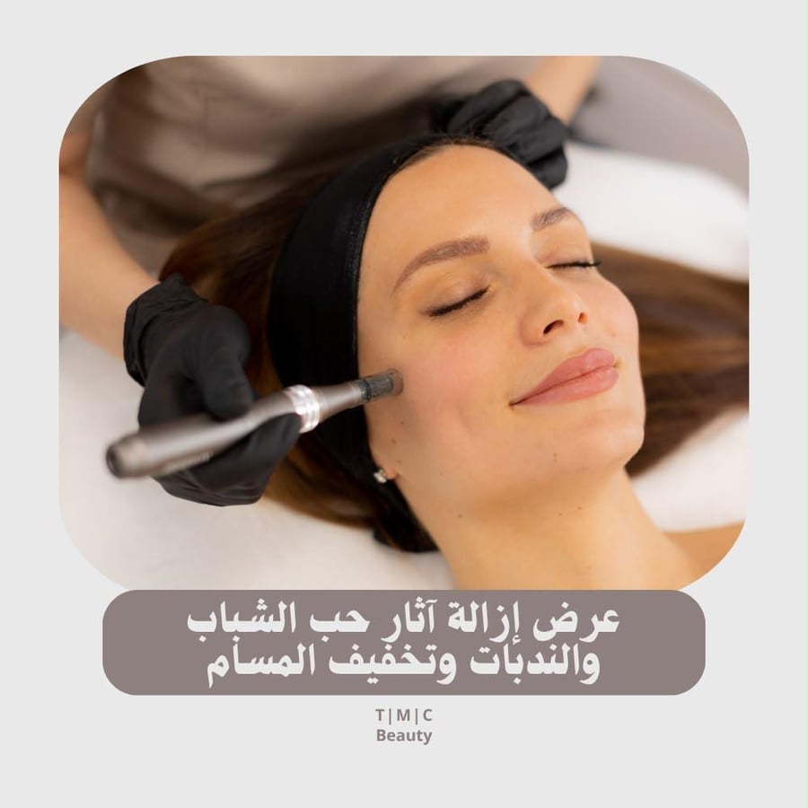 عرض إزالة اثار حب الشباب والندبات وتخفيف المسام