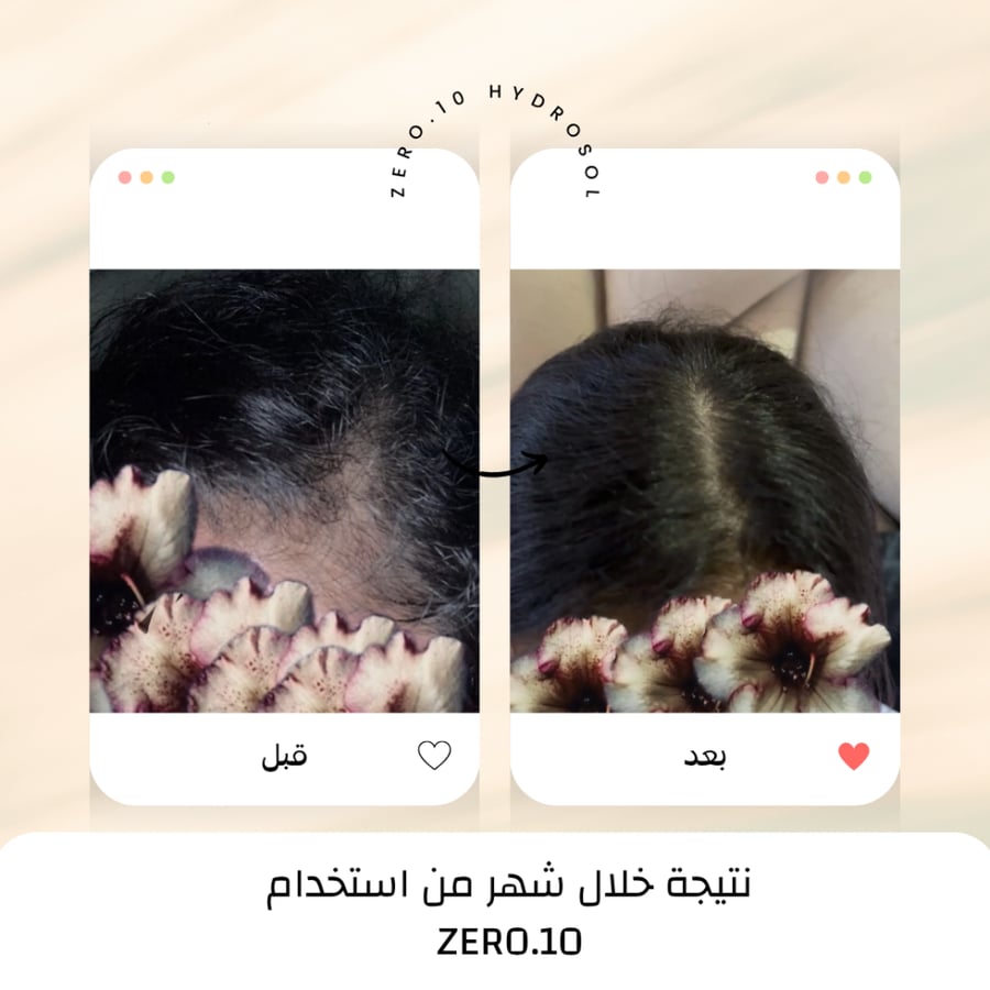 ZERO.10 نتيجة شهر لتكثيف الشعر وتقليل ظهور الفروة