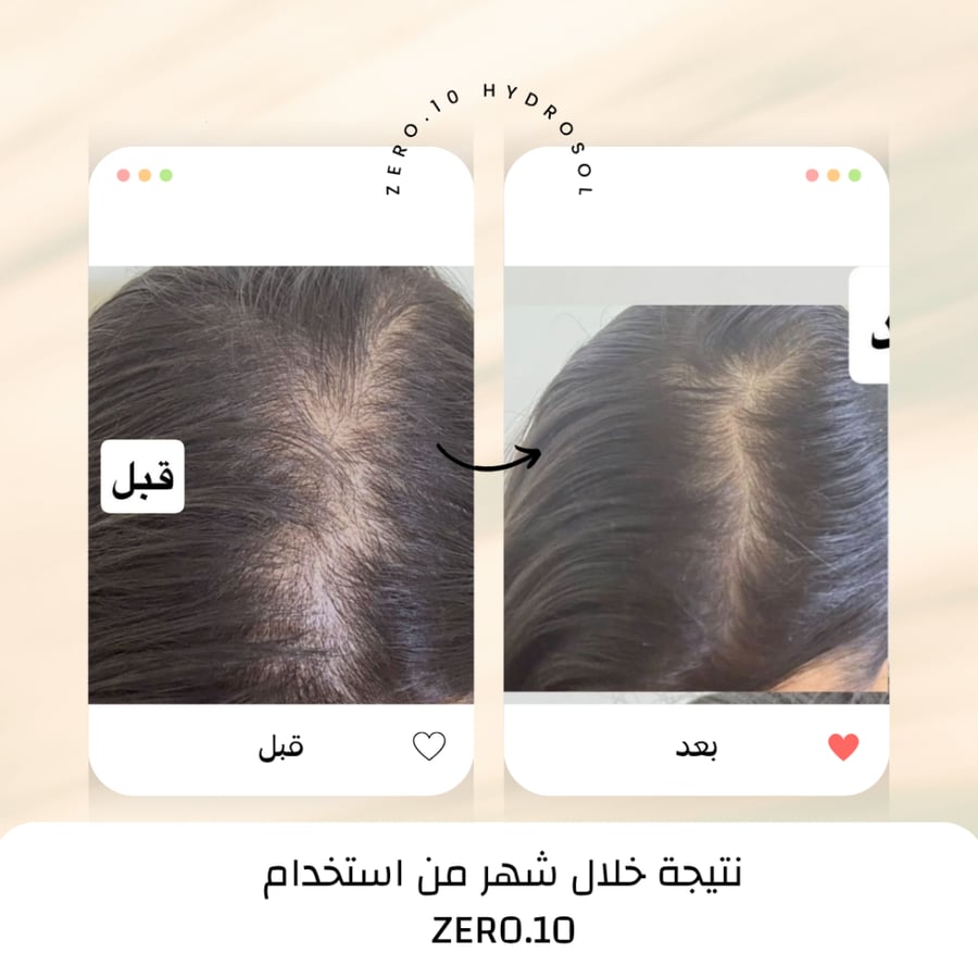 ZERO.10 صورة قبل وبعد لفرق الشعر من الأعلى