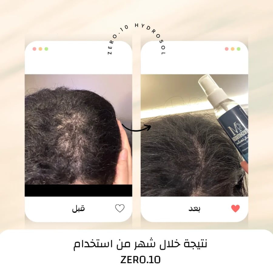 ZERO.10 قبل وبعد لخفة الشعر في أعلى الرأس