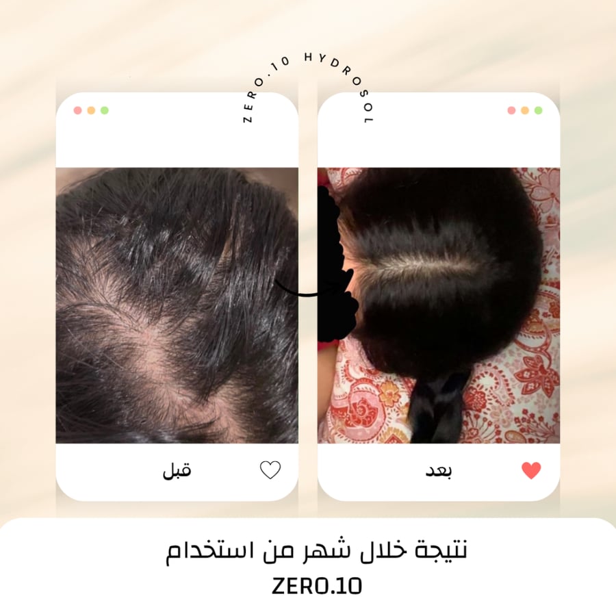 ZERO.10 نتيجة شهر لكثافة الشعر في الجزء الخلفي