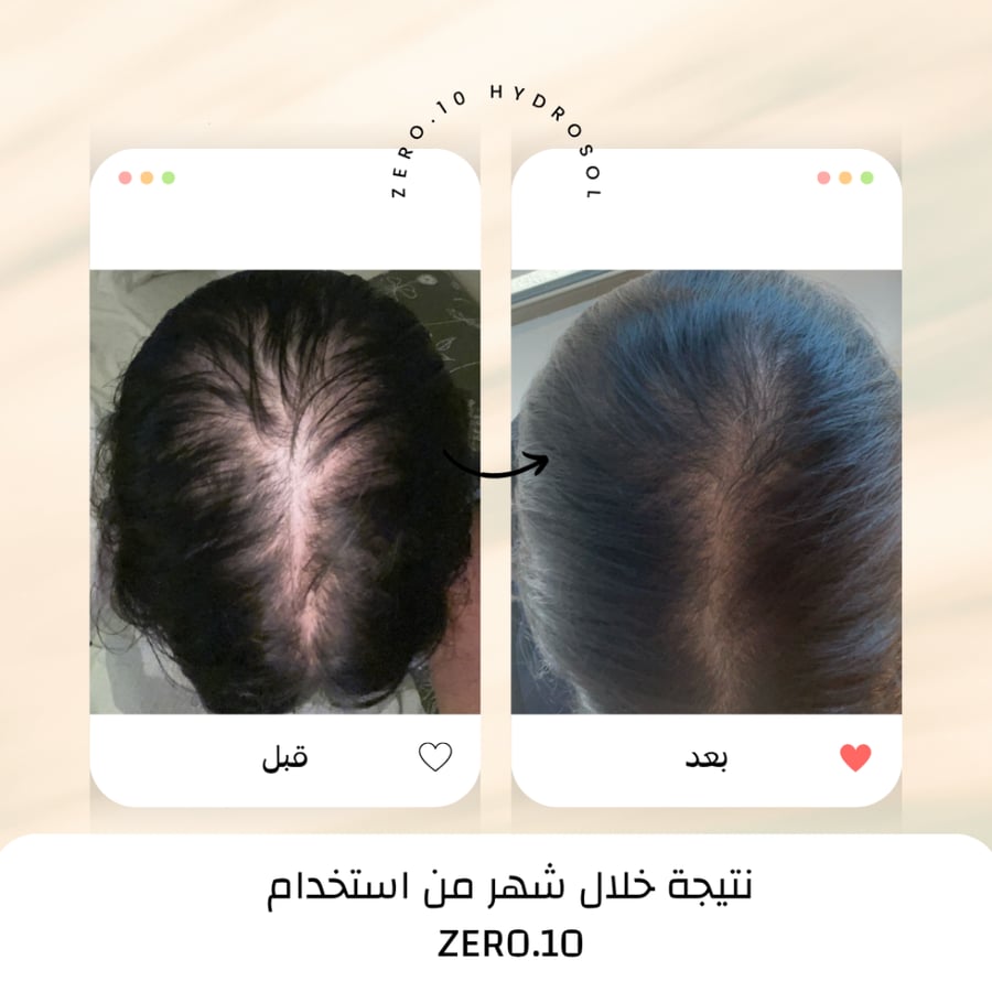 ZERO.10 صورة قبل وبعد لفرق شعر واسع لدى امرأة