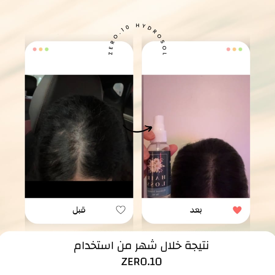 ZERO.10 نتيجة شهر لتكثيف منتصف فروة الرأس