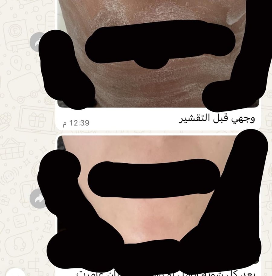 مقشر احماض تركيز ٢٠(٣٠ مل)