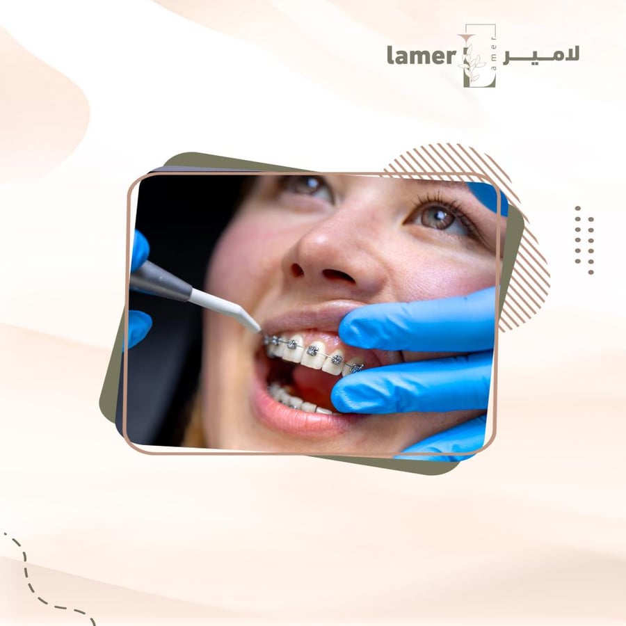 القسط الشهر للتقويم العلاجي  ( شد التقويم )