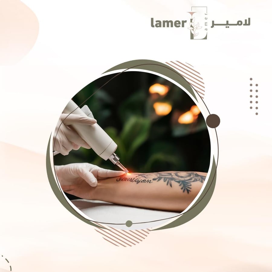 إزالة تاتو كبير