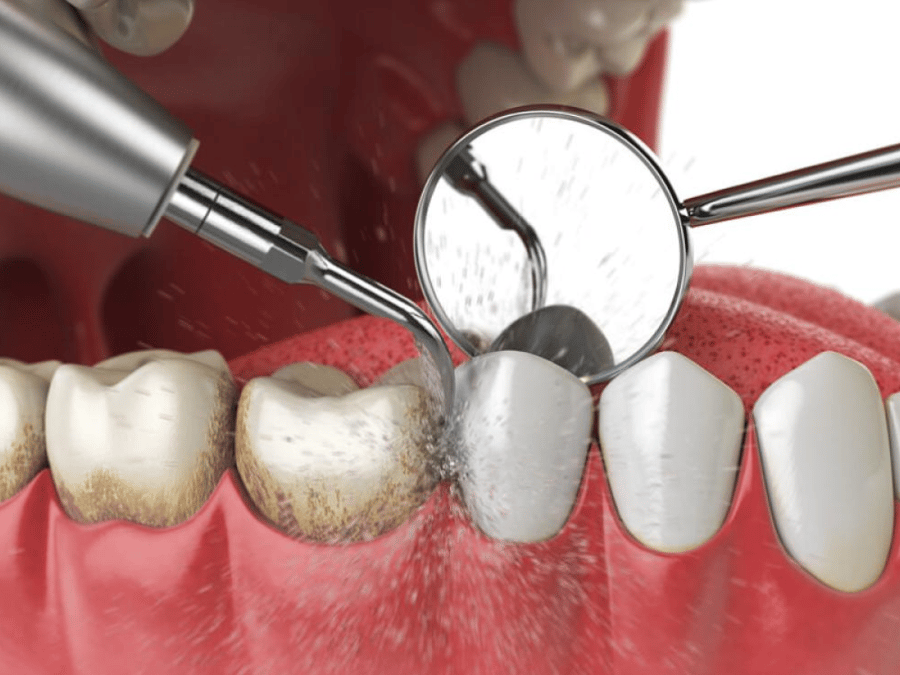 Removing tartar and polishing the teeth