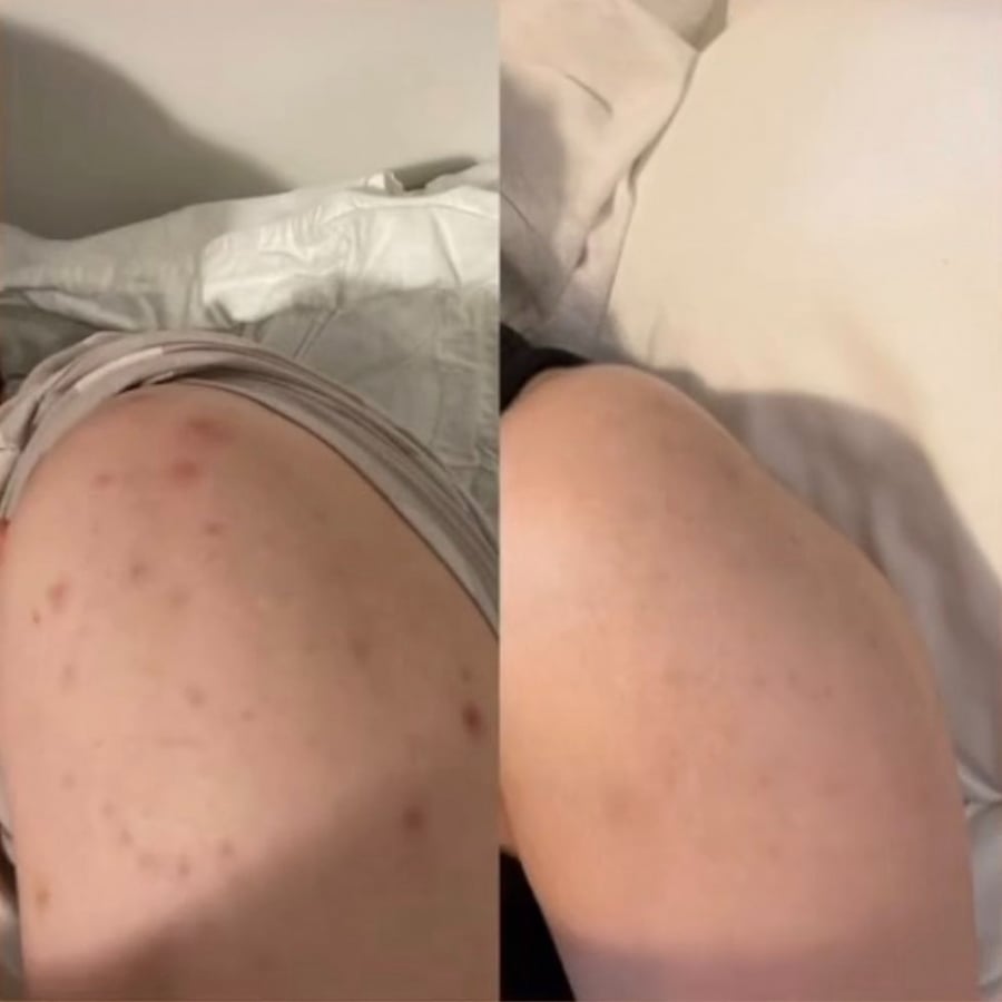 بانوكسيل‏ غسول رغوي لحب الشباب قوة قصوى مع بنزويل بيروكسيد 10٪ (156 جم)