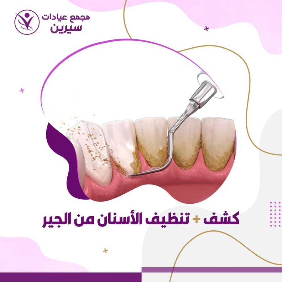 خدمة زراعة أسنان كوريه